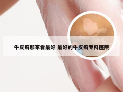 牛皮癣那家看最好 最好的牛皮癣专科医院
