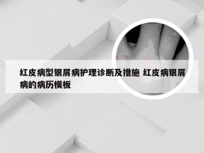 红皮病型银屑病护理诊断及措施 红皮病银屑病的病历模板