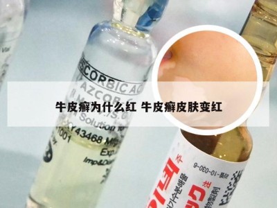 牛皮癣为什么红 牛皮癣皮肤变红