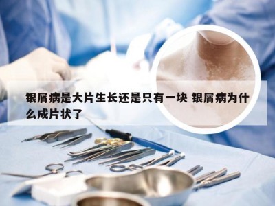 银屑病是大片生长还是只有一块 银屑病为什么成片状了
