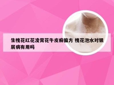 生槐花红花凌霄花牛皮癣偏方 槐花泡水对银屑病有用吗