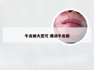 牛皮癣大悲咒 佛讲牛皮癣