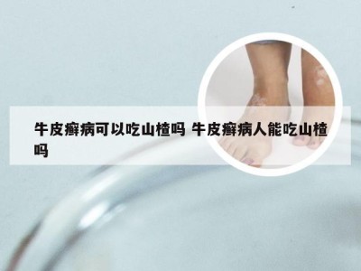 牛皮癣病可以吃山楂吗 牛皮癣病人能吃山楂吗