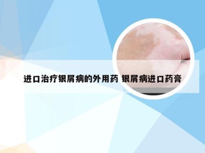进口治疗银屑病的外用药 银屑病进口药膏