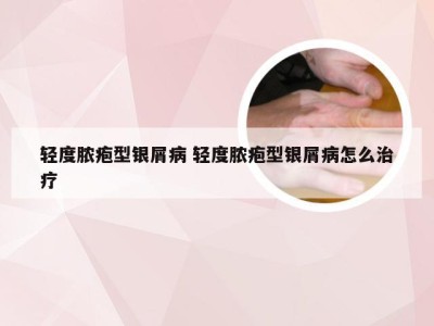 轻度脓疱型银屑病 轻度脓疱型银屑病怎么治疗