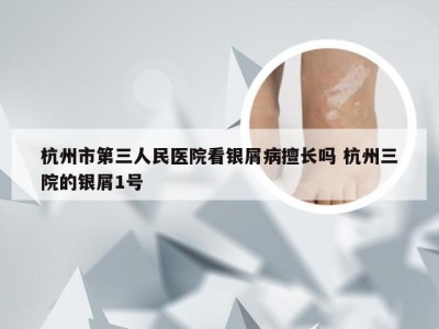 杭州市第三人民医院看银屑病擅长吗 杭州三院的银屑1号