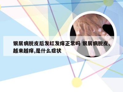银屑病脱皮后发红发痒正常吗 银屑病脱皮,越来越痒,是什么症状