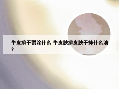 牛皮癣干裂涂什么 牛皮肤癣皮肤干抹什么油?
