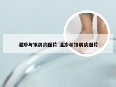 湿疹与银屑病图片 湿疹和银屑病图片