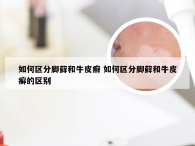如何区分脚藓和牛皮癣 如何区分脚藓和牛皮癣的区别