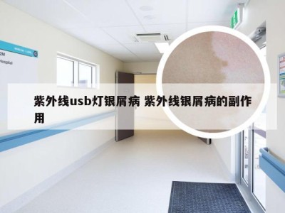 紫外线usb灯银屑病 紫外线银屑病的副作用