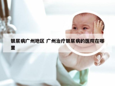 银屑病广州地区 广州治疗银屑病的医院在哪里