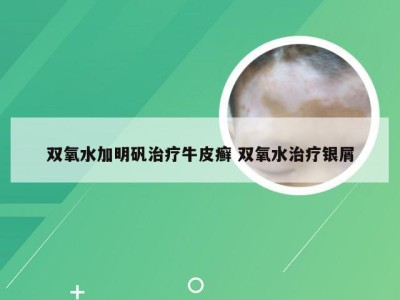 双氧水加明矾治疗牛皮癣 双氧水治疗银屑
