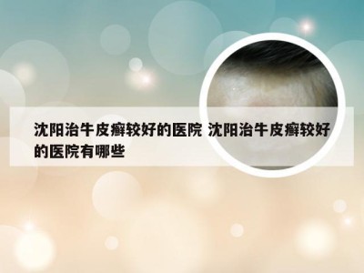 沈阳治牛皮癣较好的医院 沈阳治牛皮癣较好的医院有哪些