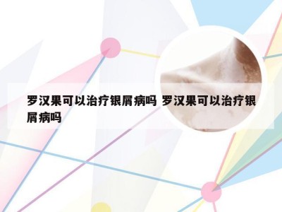 罗汉果可以治疗银屑病吗 罗汉果可以治疗银屑病吗