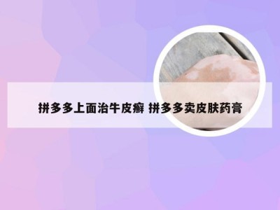 拼多多上面治牛皮癣 拼多多卖皮肤药膏