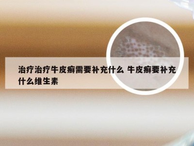 治疗治疗牛皮癣需要补充什么 牛皮癣要补充什么维生素