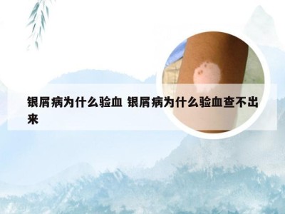 银屑病为什么验血 银屑病为什么验血查不出来