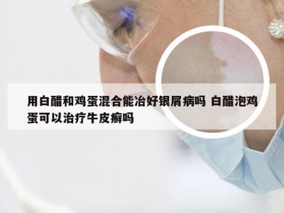 用白醋和鸡蛋混合能冶好银屑病吗 白醋泡鸡蛋可以治疗牛皮癣吗