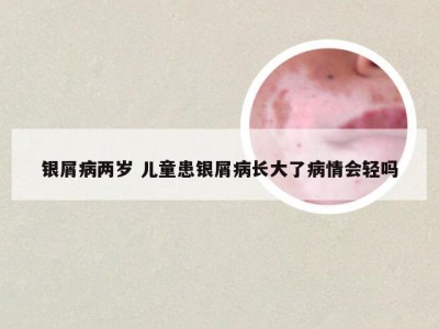 银屑病两岁 儿童患银屑病长大了病情会轻吗