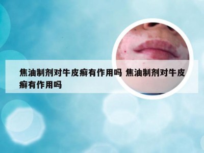 焦油制剂对牛皮癣有作用吗 焦油制剂对牛皮癣有作用吗