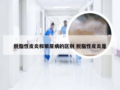脱脂性皮炎和银屑病的区别 脱脂性皮炎是