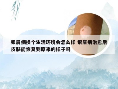 银屑病换个生活环境会怎么样 银屑病治愈后皮肤能恢复到原来的样子吗