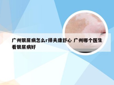 广州银屑病怎么r择夫康舒心 广州哪个医生看银屑病好