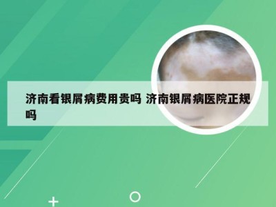 济南看银屑病费用贵吗 济南银屑病医院正规吗
