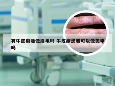有牛皮癣能做眉毛吗 牛皮癣患者可以做美甲吗