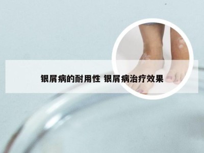 银屑病的耐用性 银屑病治疗效果