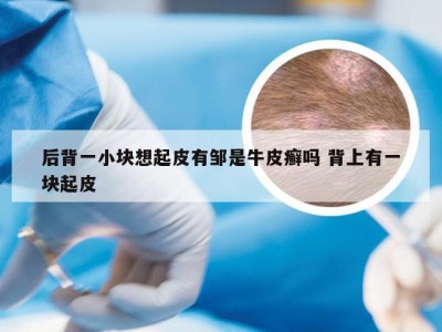后背一小块想起皮有邹是牛皮癣吗 背上有一块起皮