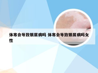 体寒会导致银屑病吗 体寒会导致银屑病吗女性