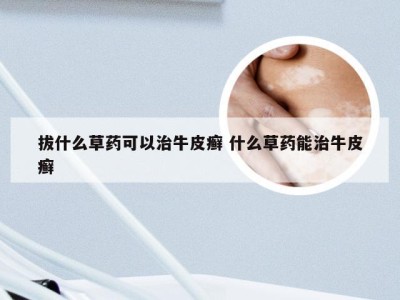拔什么草药可以治牛皮癣 什么草药能治牛皮癣