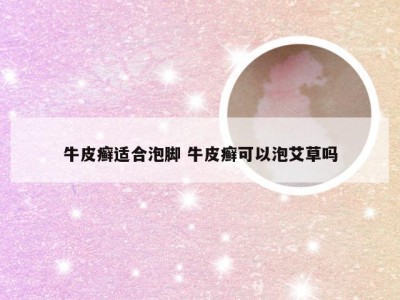 牛皮癣适合泡脚 牛皮癣可以泡艾草吗