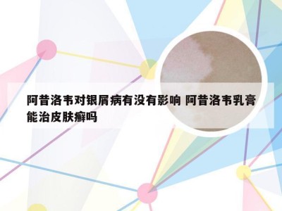 阿昔洛韦对银屑病有没有影响 阿昔洛韦乳膏能治皮肤癣吗