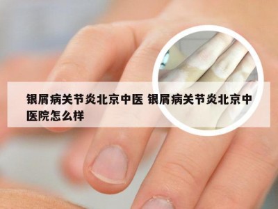 银屑病关节炎北京中医 银屑病关节炎北京中医院怎么样