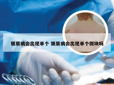 银屑病会出现单个 银屑病会出现单个斑块吗