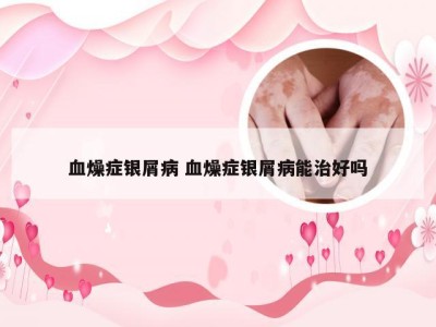血燥症银屑病 血燥症银屑病能治好吗