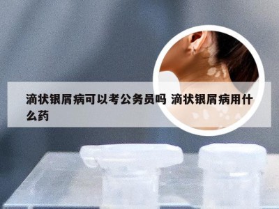 滴状银屑病可以考公务员吗 滴状银屑病用什么药