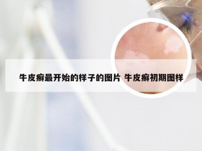 牛皮癣最开始的样子的图片 牛皮癣初期图样