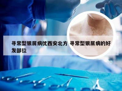 寻常型银屑病优西安北方 寻常型银屑病的好发部位