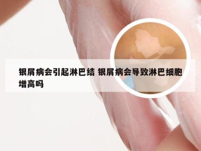 银屑病会引起淋巴结 银屑病会导致淋巴细胞增高吗