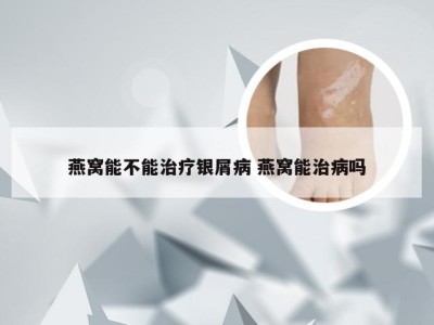 燕窝能不能治疗银屑病 燕窝能治病吗