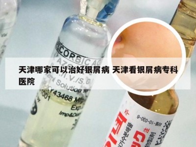 天津哪家可以治好银屑病 天津看银屑病专科医院