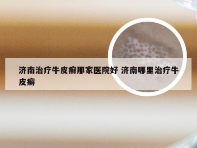 济南治疗牛皮癣那家医院好 济南哪里治疗牛皮癣