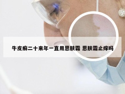牛皮癣二十来年一直用恩肤霜 恩肤霜止痒吗