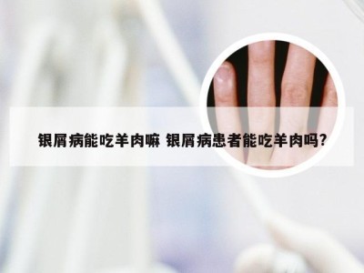银屑病能吃羊肉嘛 银屑病患者能吃羊肉吗?