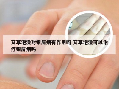 艾草泡澡对银屑病有作用吗 艾草泡澡可以治疗银屑病吗