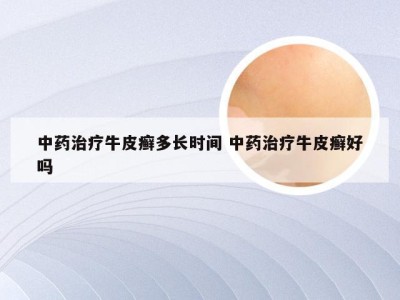 中药治疗牛皮癣多长时间 中药治疗牛皮癣好吗